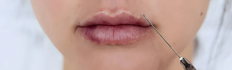 از بین بردن کبودی لب بعد از تزریق ژل