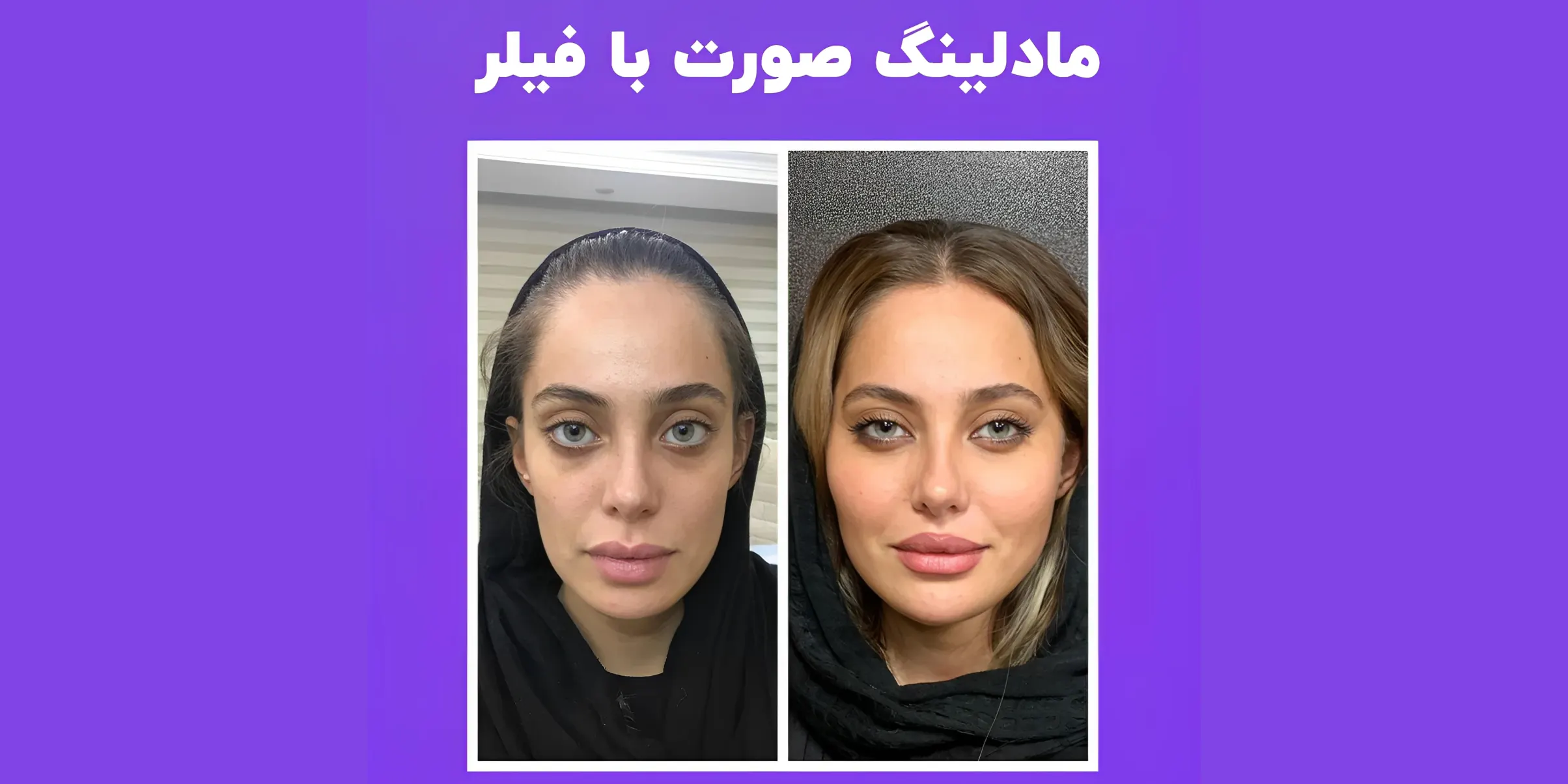 همه چیز درباره فیلر صورت