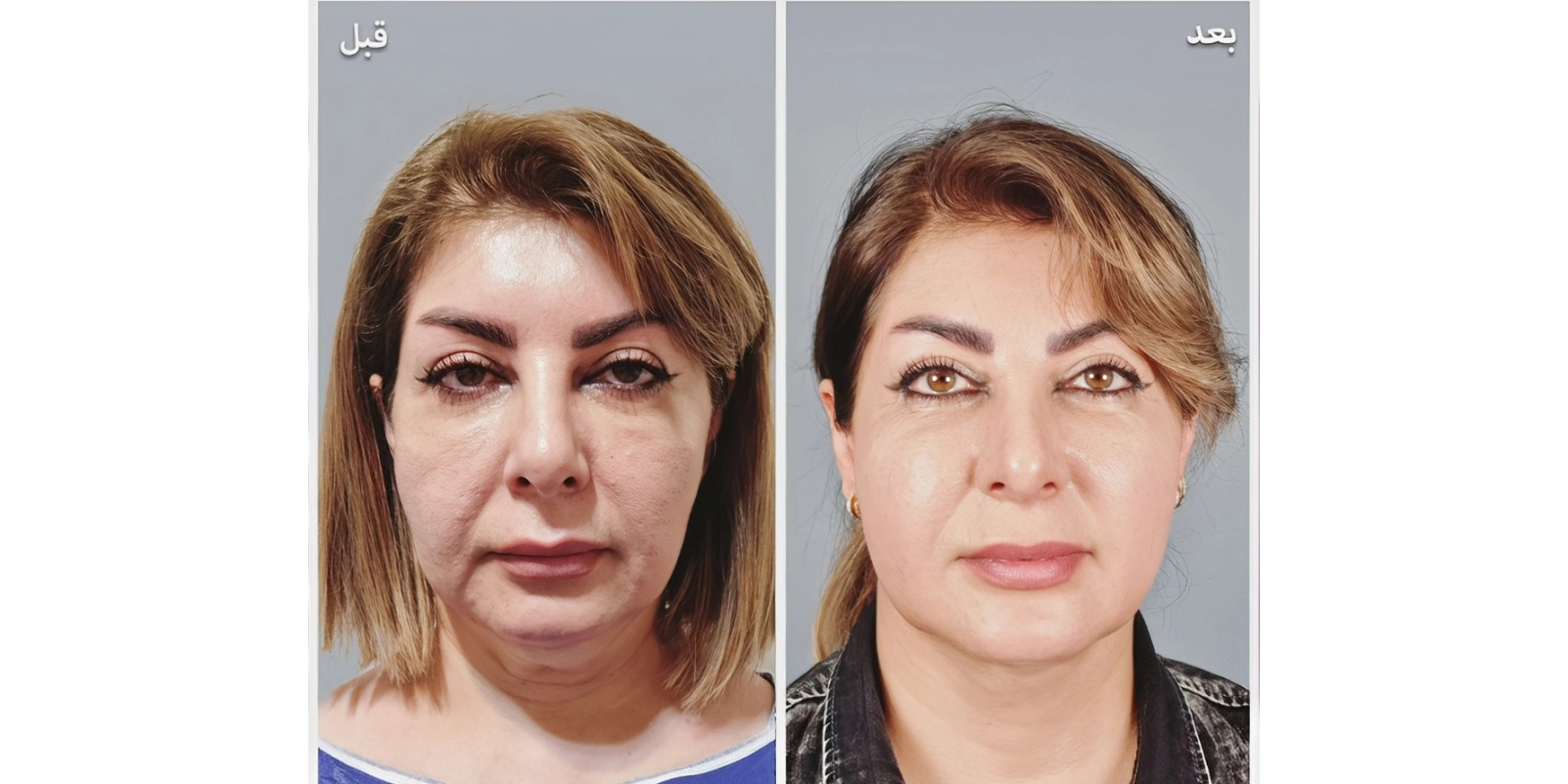 عکس قبل و بعد مزوتراپی غبغب