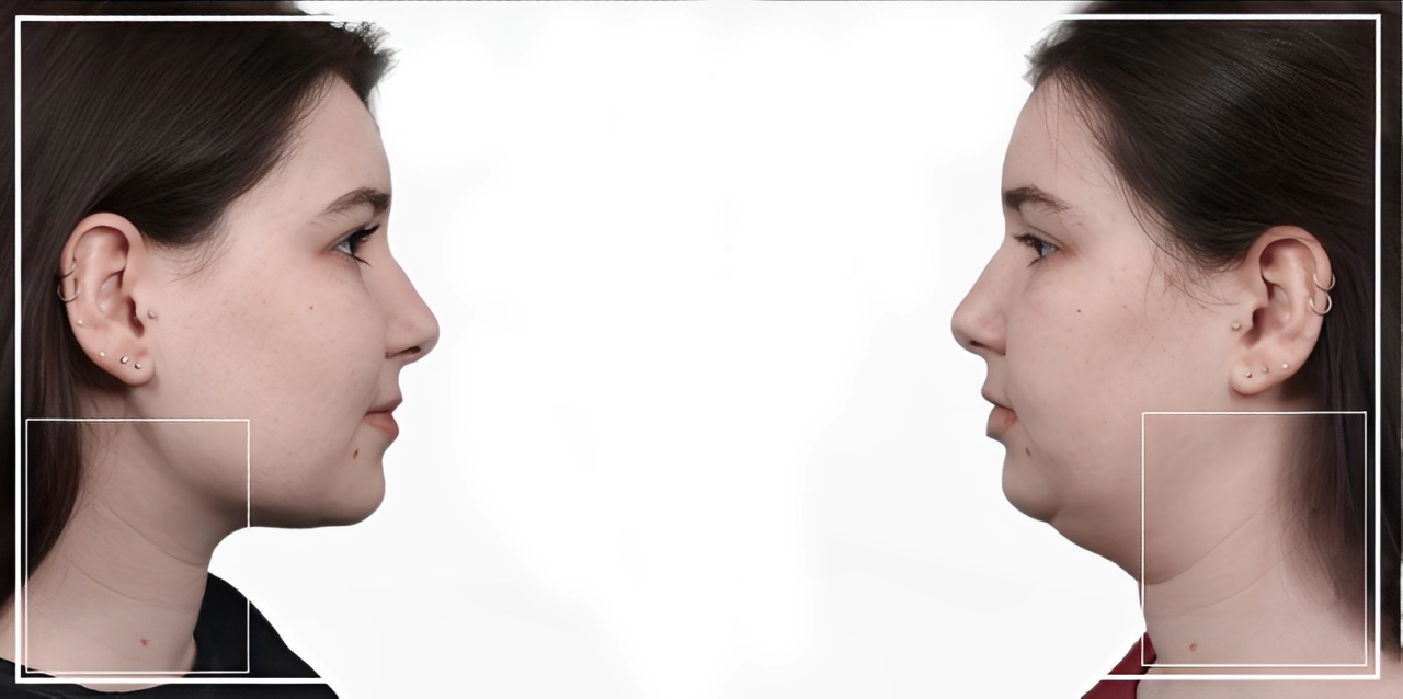 عکس قبل و بعد مزوتراپی غبغب
