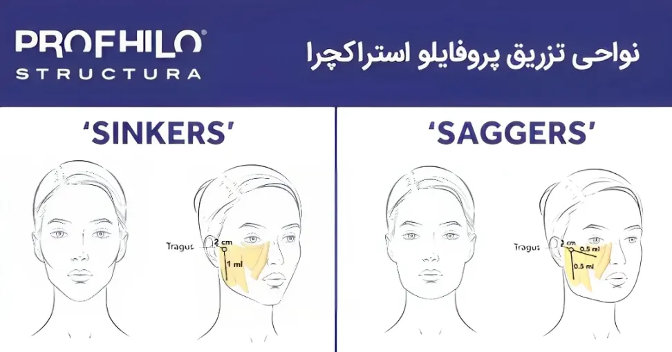 نحوه تزریق پروفایلو استراکچرا