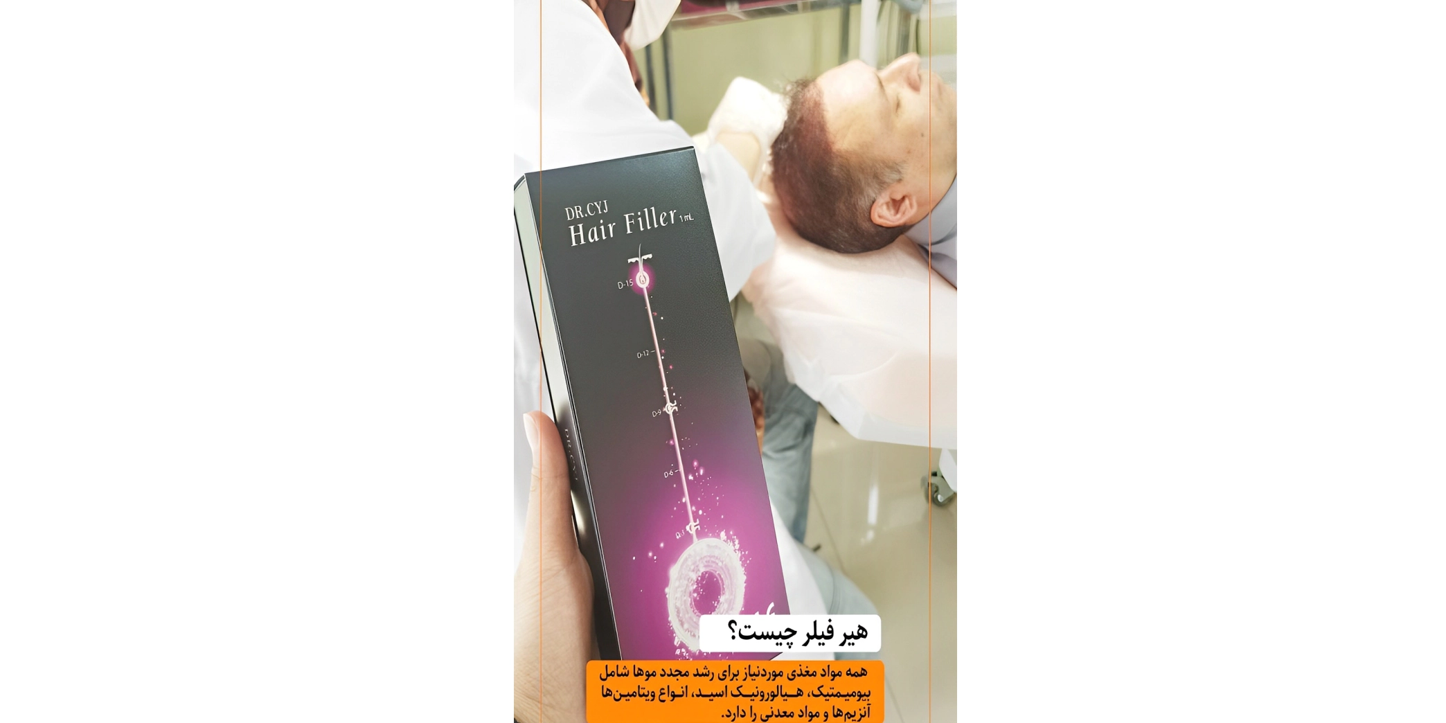 بهترین زمان تزریق هیر فیلر بعد از کاشت مو