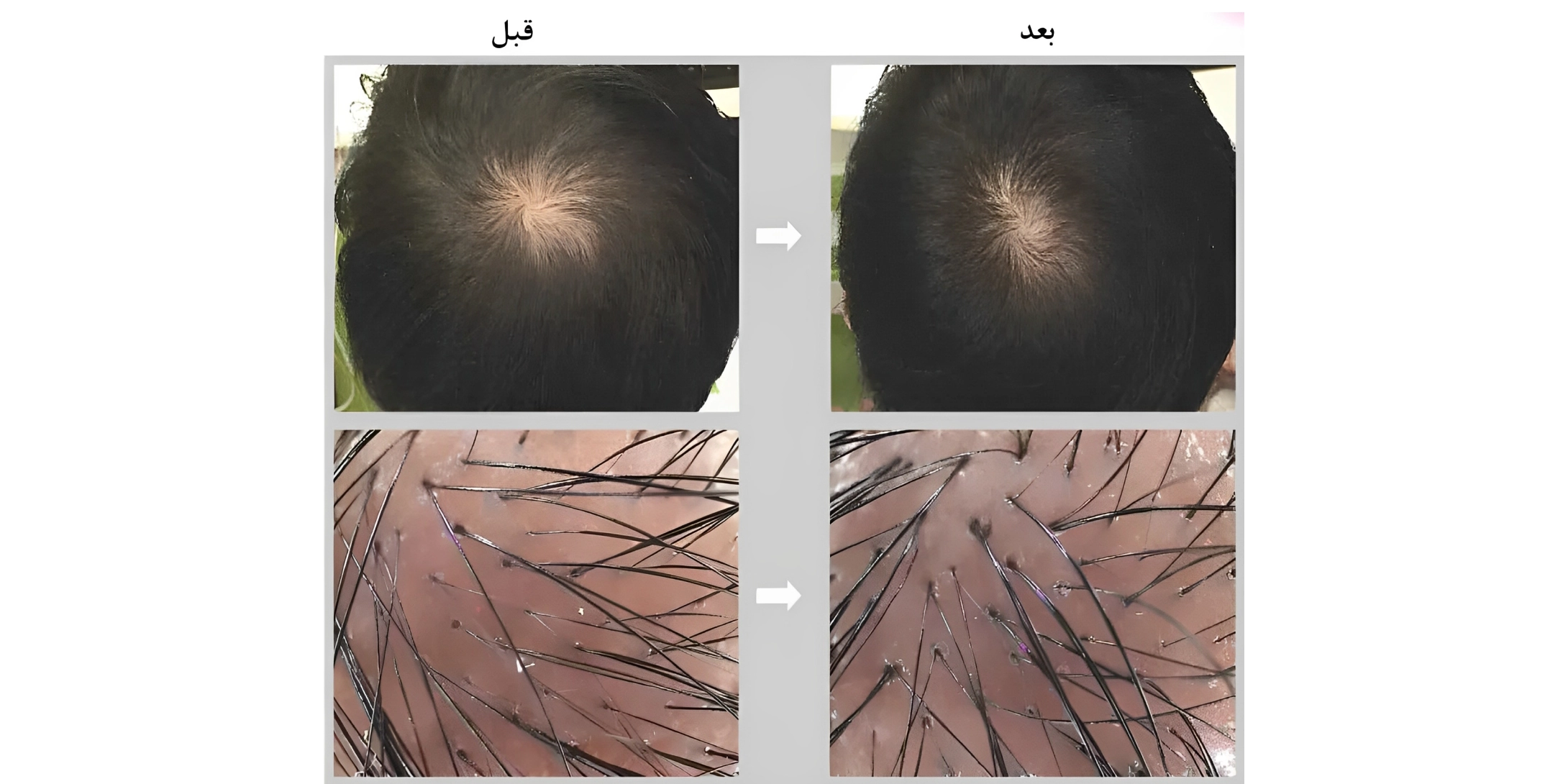 مراحل تزریق هیر فیلر
