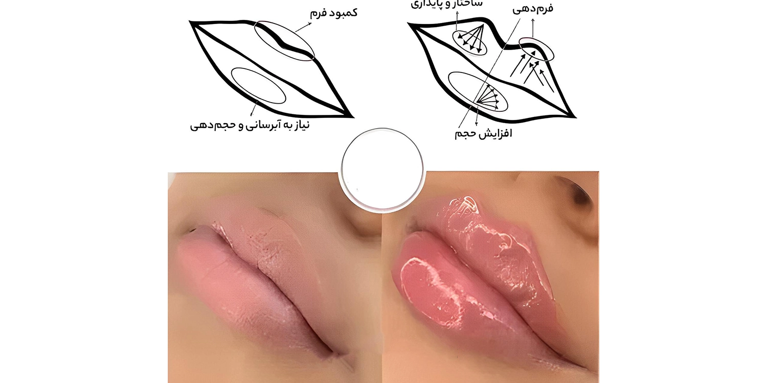 فیلر نورافیل