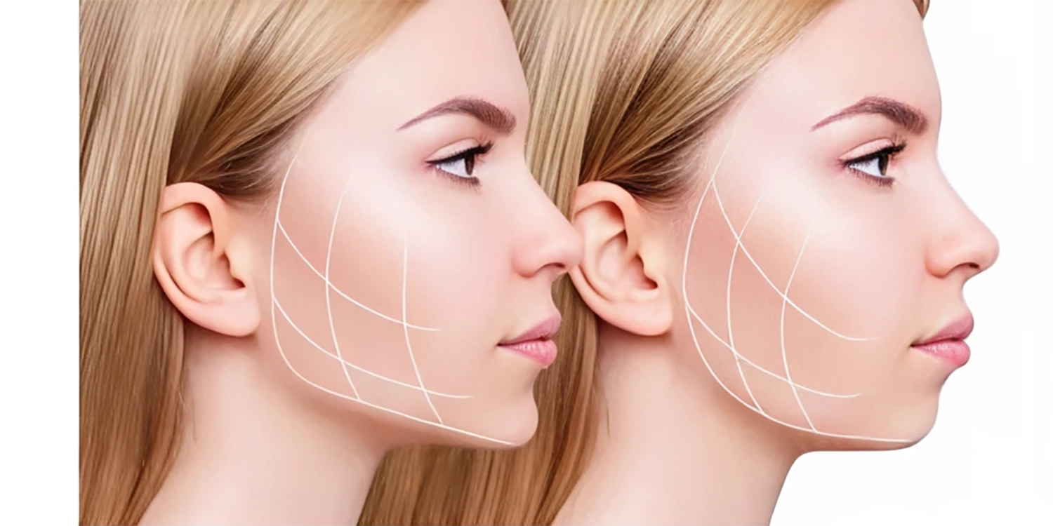 تقویت فک و ایجاد تعادل چهره با فیلر چانه