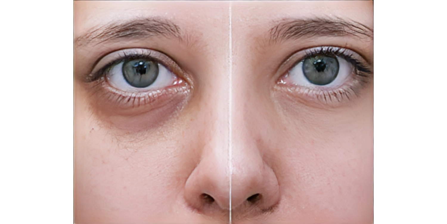 خطرات فیلر زیر چشم و نحوه پیشگیری